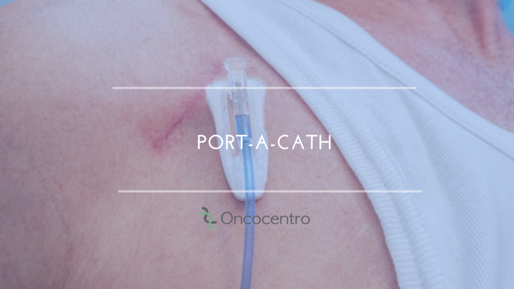 PortACath (Cateter totalmente implantado) Oncocentro PortACath (Cateter totalmente implantado) Oncocentro